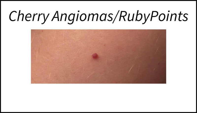 cherry angiomas / ruby points