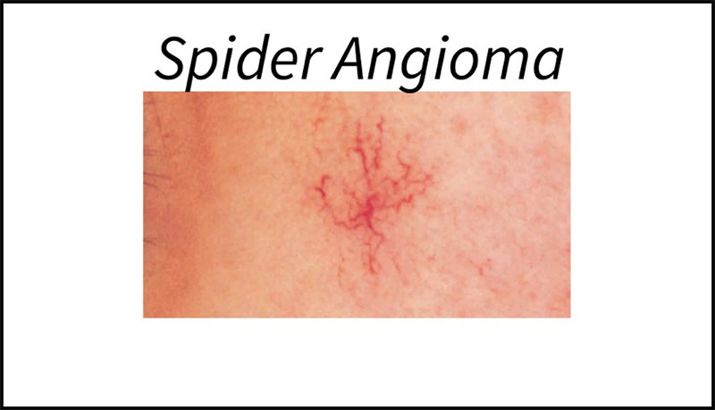 spider angioma